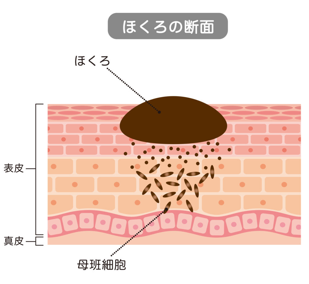 ほくろ