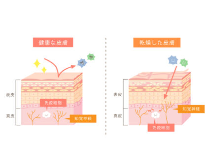 アトピー性皮膚炎の原因